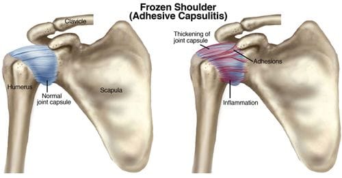 Adhesive Capsulitis